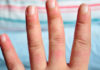 Qué son los sabañones, cómo se tratan y 6 claves para prevenirlos