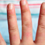 Qué son los sabañones, cómo se tratan y 6 claves para prevenirlos