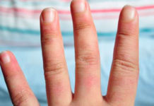 Qué son los sabañones, cómo se tratan y 6 claves para prevenirlos