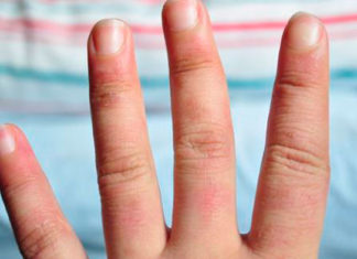 Qué son los sabañones, cómo se tratan y 6 claves para prevenirlos