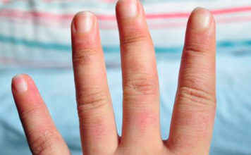 Qué son los sabañones, cómo se tratan y 6 claves para prevenirlos