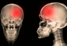 Qué es un ACV y cómo se puede prevenir