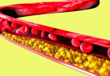 Innovadora inyección contra el colesterol LDL