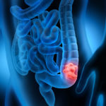 cancerdecolon-foto1-principal