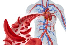 Anemia falciforme: radiografía de un trastorno hereditario de la sangre