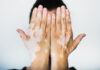 Qué es y cómo se trata la enfermedad de la piel llamada vitiligo