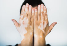 Qué es y cómo se trata la enfermedad de la piel llamada vitiligo