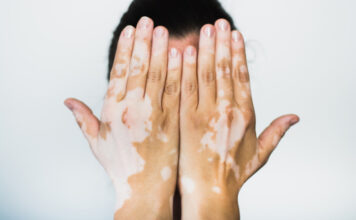 Qué es y cómo se trata la enfermedad de la piel llamada vitiligo