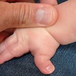 Rubinstein–Taybi: el síndrome de los pulgares anchos