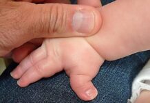 Rubinstein–Taybi: el síndrome de los pulgares anchos