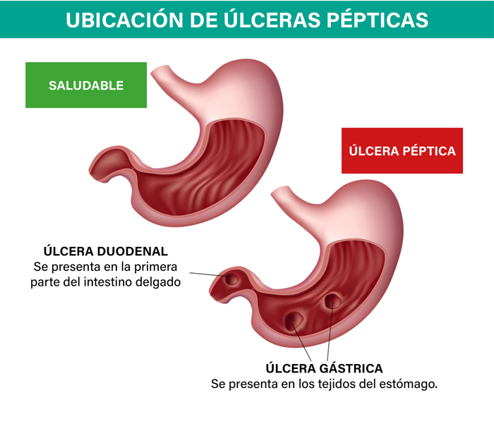 Úlceras: qué son, cómo se previenen y cuál es su tratamiento | DrCormillot