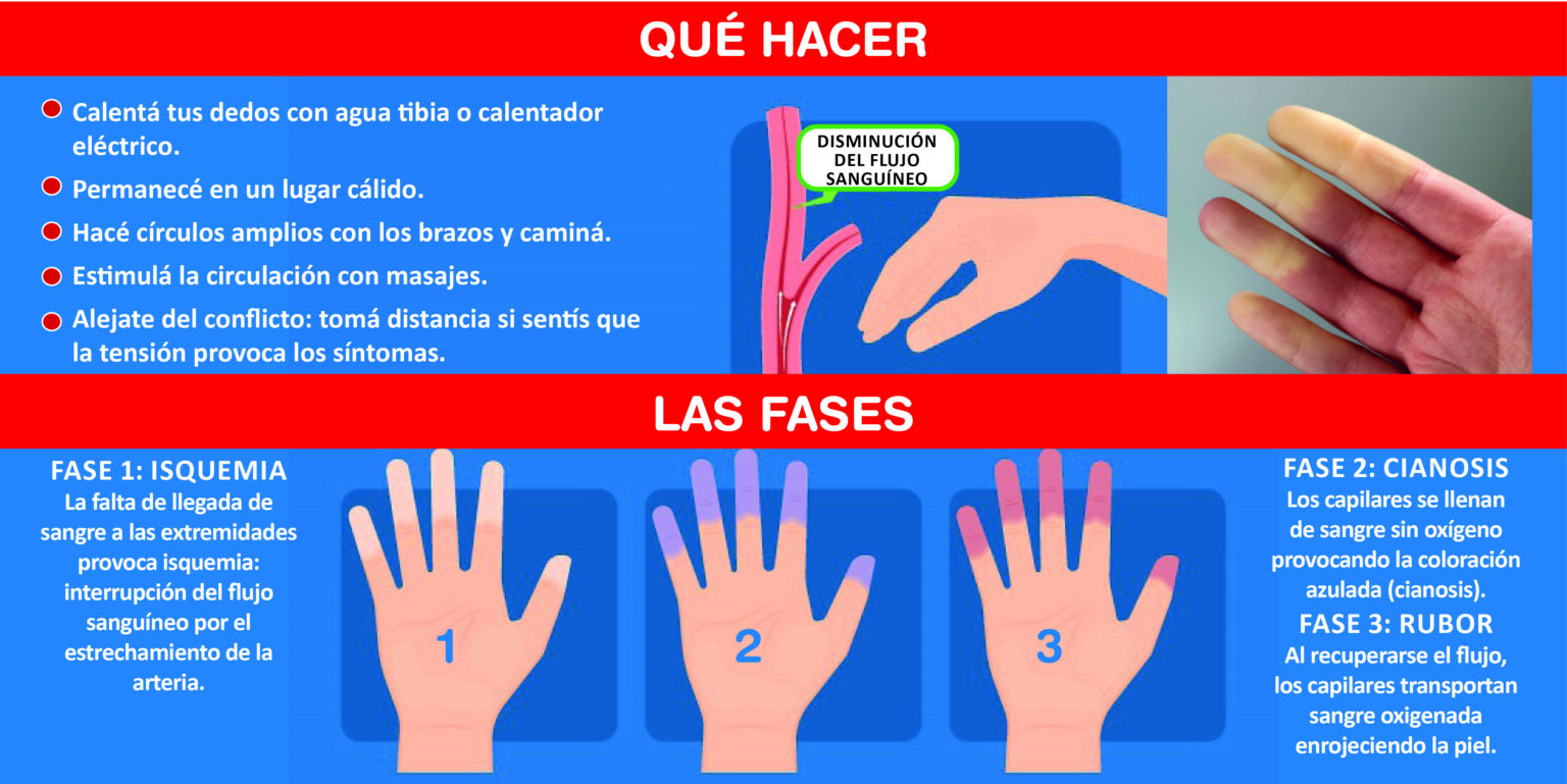 Qué es el fenómeno de Raynaud: la enfermedad de los dedos azules ...
