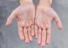 DISHIDROSIS: ¿QUÉ ES, CUÁLES SON LOS SÍNTOMAS Y CÓMO SE TRATA?