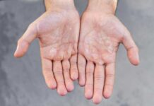 DISHIDROSIS: ¿QUÉ ES, CUÁLES SON LOS SÍNTOMAS Y CÓMO SE TRATA?