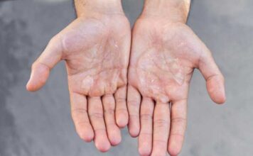 DISHIDROSIS: ¿QUÉ ES, CUÁLES SON LOS SÍNTOMAS Y CÓMO SE TRATA?