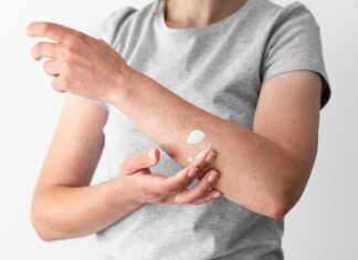 Según expertos, ¿Cómo la dermatitis atópica impacta en el descanso y el bienestar?