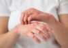 Pérdida de peso mejora significativamente la psoriasis y calidad de vida de los pacientes.