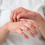 Pérdida de peso mejora significativamente la psoriasis y calidad de vida de los pacientes.