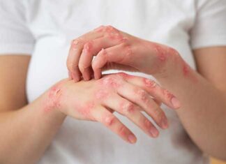 Pérdida de peso mejora significativamente la psoriasis y calidad de vida de los pacientes.