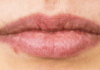 Herpes labial: ¿se puede eliminar para siempre?