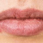 Herpes labial: ¿se puede eliminar para siempre?