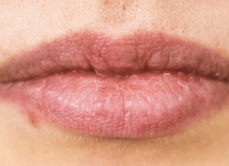 Herpes labial: ¿se puede eliminar para siempre?