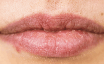Herpes labial: ¿se puede eliminar para siempre?