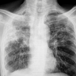 Fibrosis quística: mucho más que un problema respiratorio