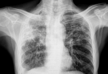 Fibrosis quística: mucho más que un problema respiratorio