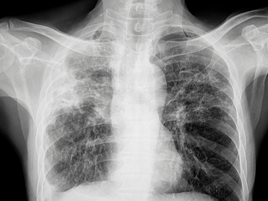 Fibrosis quística: mucho más que un problema respiratorio